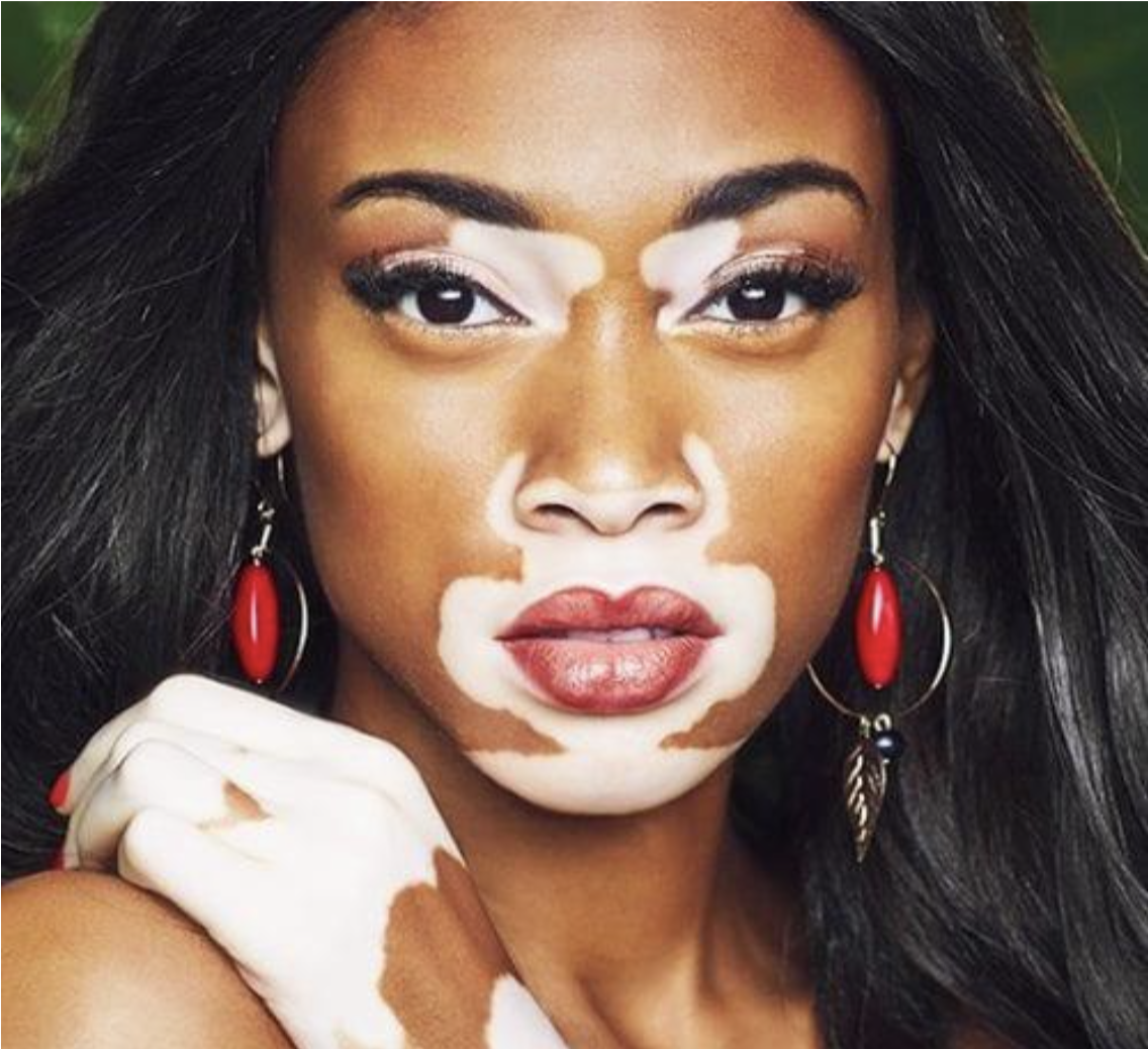 Winnie Harlow, le mannequin qui s&rsquo;impose… avec le vitiligo.